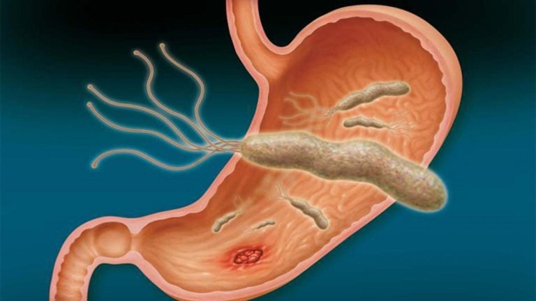 Đau dạ dày có vi khuẩn HP dương tính – Nhờ tìm ra cách này mà thoát bệnh bất ngờ
